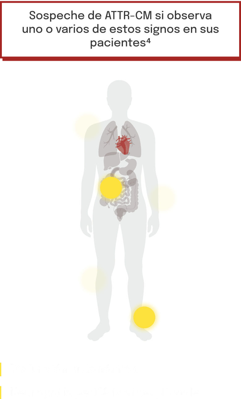 Diagrama que muestra la disfunción autonómica y la neuropatía periférica en la ATTR‑CM
