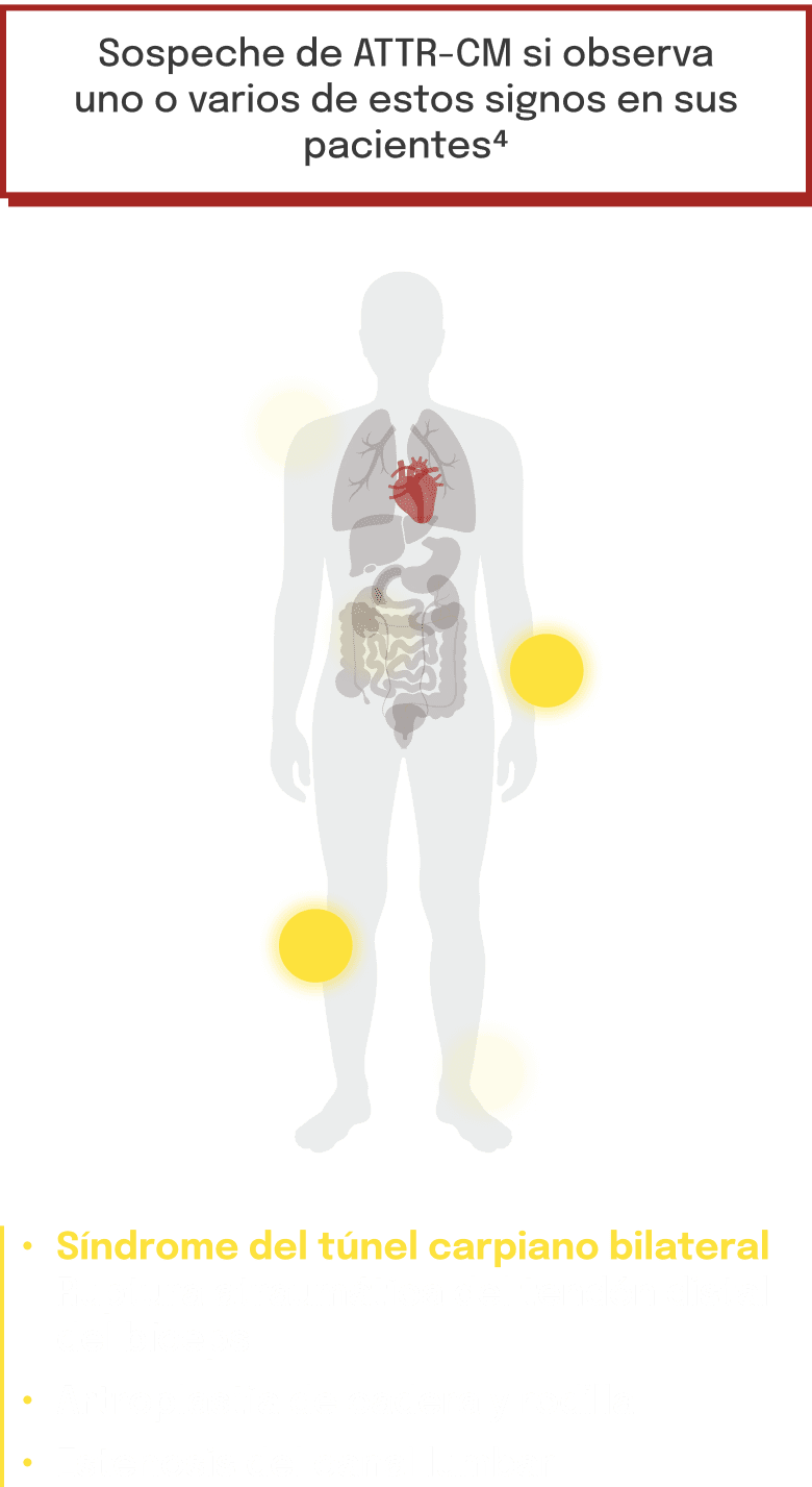Principales señales de alerta de IC asociadas a la ATTR‑CM