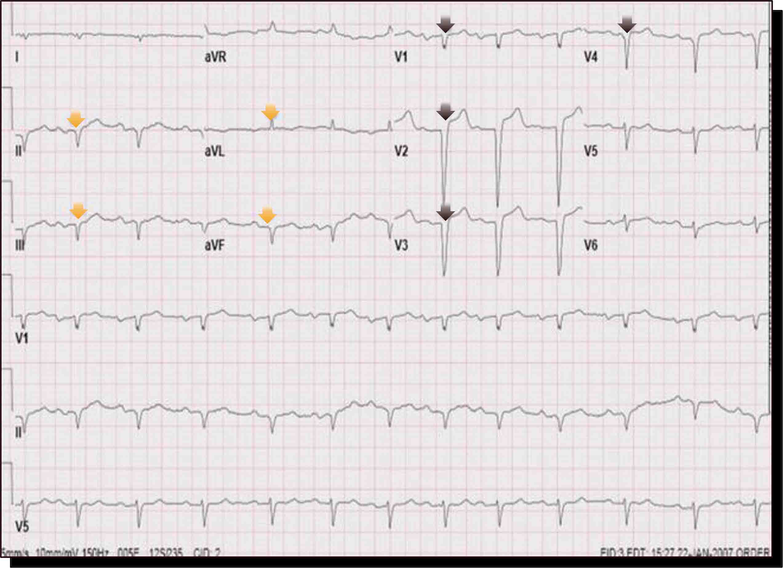 ECG que muestra un patrón de QRS de bajo voltaje con anomalías destacadas en múltiples derivaciones