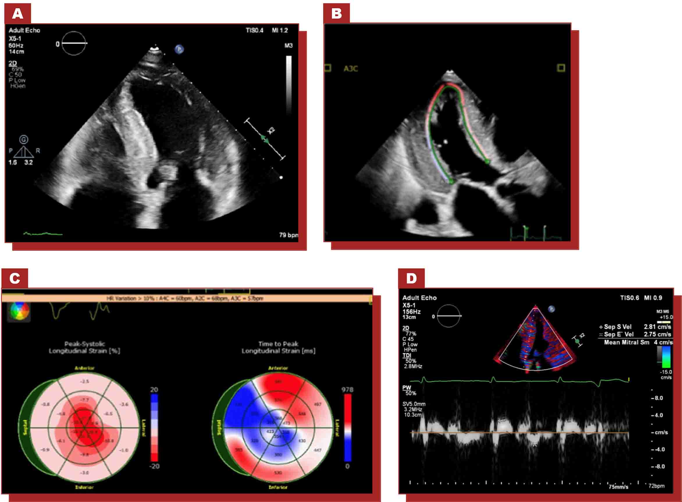 Ecocardiografía que muestra la estructura cardíaca, el análisis del strain longitudinal y mediciones Doppler.
