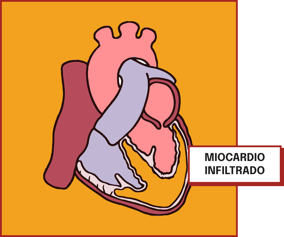 Miocardio infiltrado
