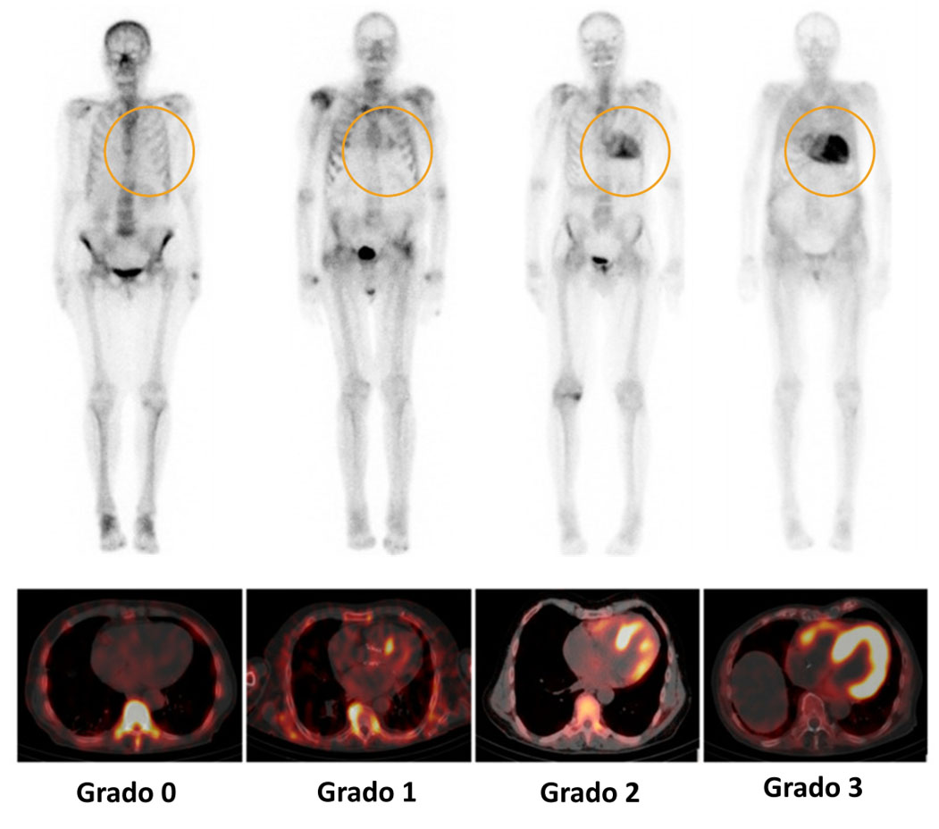 Imágenes de gammagrafía que muestran los grados Perugini de 0 a 3 para la ATTR‑CM
