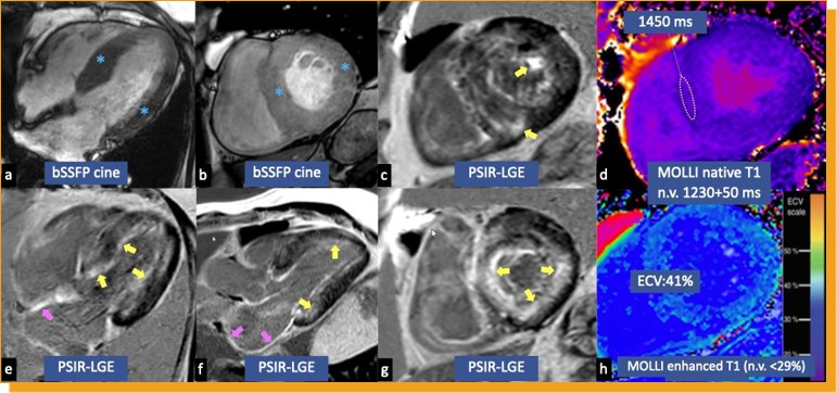 Resonancia magnética cardíaca que muestra secuencias cine bSSFP, hallazgos PSIR‑LGE y mapeo T1 con ECV elevado